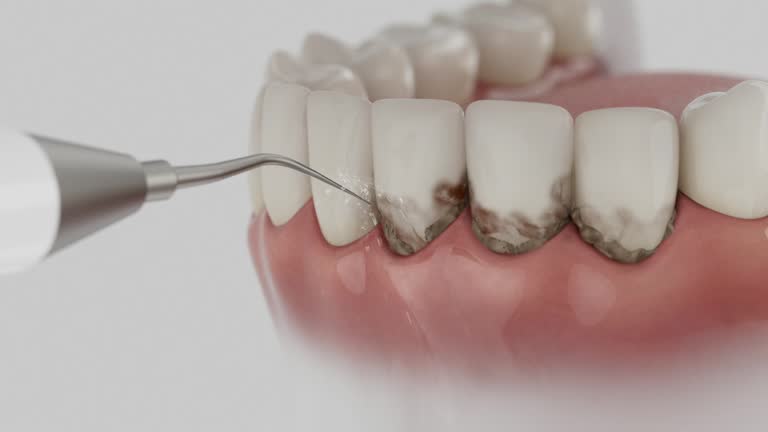 Trusted Dental Crowns And Bridges service in Centennial, CO - Dentist Open Now